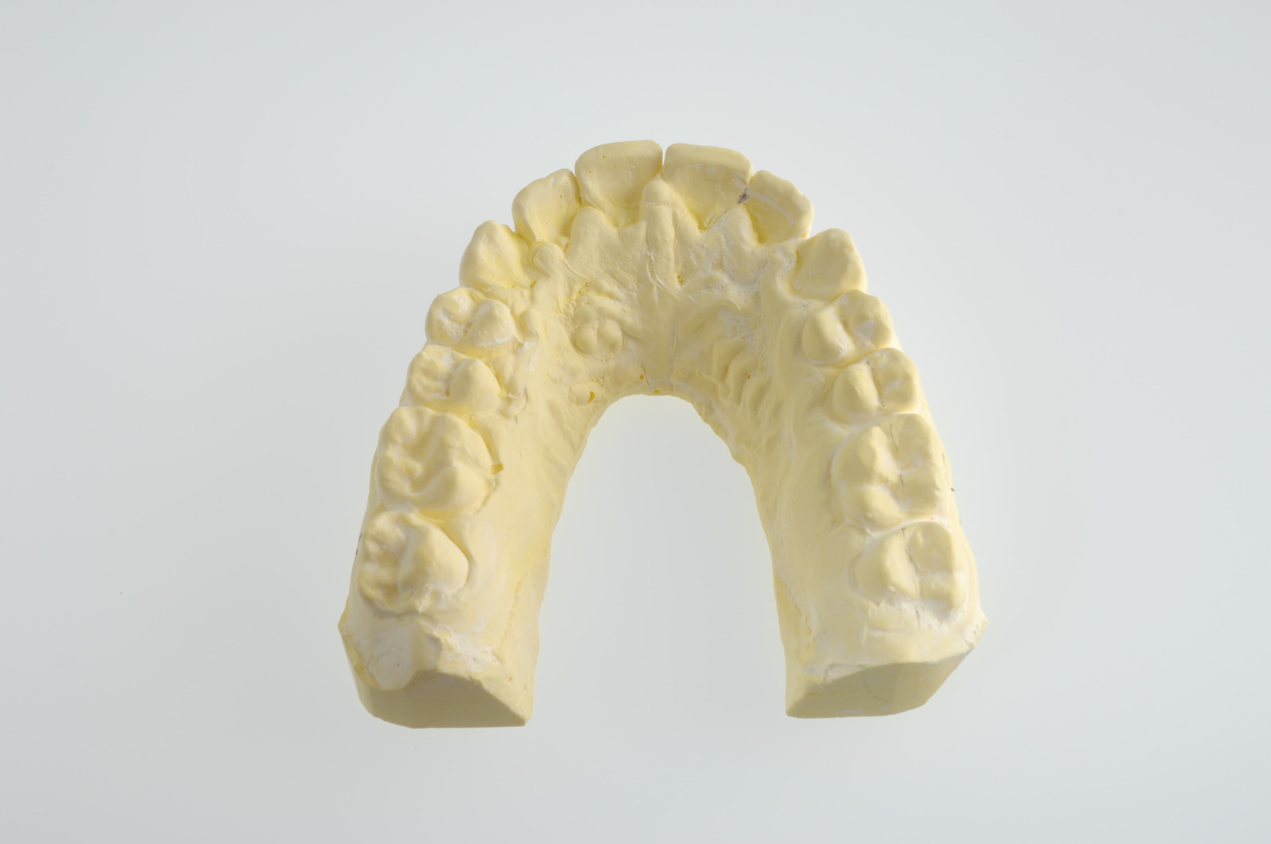 The plaster model will be scanned to create a treatment plan (recently with a direct intraoral scan)